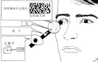 義眼適合什么樣的患者？